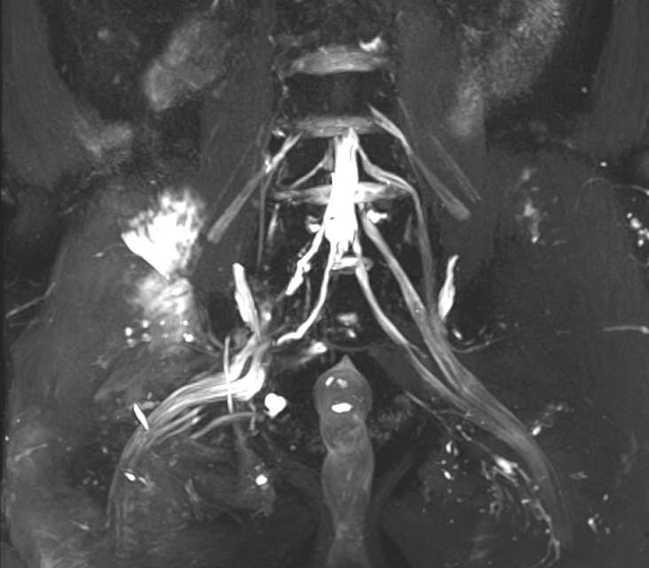 成功实施世界首例机器人辅助坐骨大孔扩大截骨,腰骶丛神经修复手术